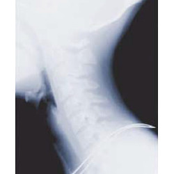 Cervico 2000 - urządzenie do trakcji kręgosłupa szyjnego