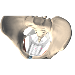 Calistar S - system do leczenia cystocele