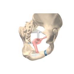 Splentis – system sakrospinalnej cyrwikopeksji do leczenia wypadania szyjki