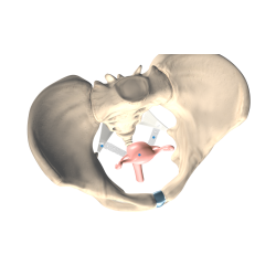 Splentis – system sakrospinalnej cyrwikopeksji do leczenia wypadania szyjki