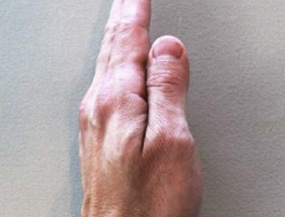 Zdjęcie 8: Przywodzenie dłoniowe