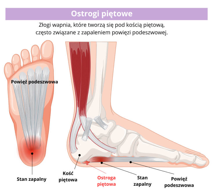 Schemat medyczny ostrogi piętowej z oznaczeniem anatomii stopy i powięzi podeszwowej