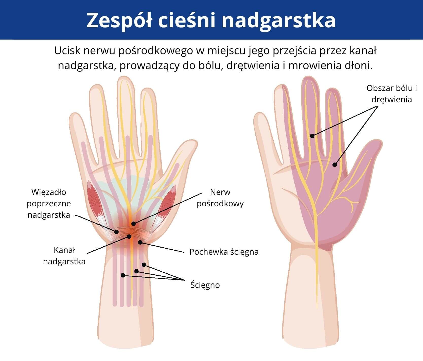 Infografika przedstawiająca zespół cieśni nadgarstka. Po lewej budowa nadgarstka z zaznaczonym kanałem nadgarstka, więzadłem poprzecznym, nerwem pośrodkowym i ścięgnami, ukazująca miejsce ucisku. Po prawej dłoń z zaznaczonym obszarem bólu i drętwienia unerwionym przez nerw pośrodkowy (kciuk, palce wskazujący, środkowy i połowa serdecznego).
