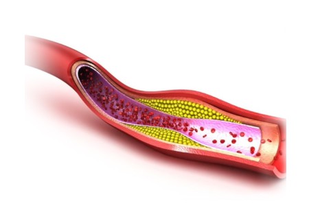 Ograniczony przepływ w tętnicy i żyłach powoduje niesatysfakcjonującą erekcję