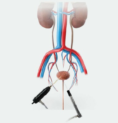 URETERORENOSKOPIA (URS)