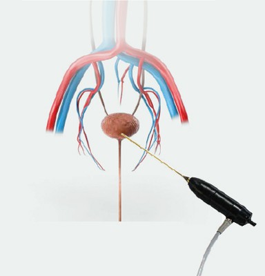 LITOTRYPSJA W PĘCHERZU MOCZOWYM