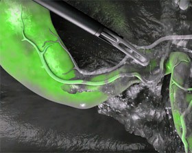 Dowiedź się więcej na temat obrazowania fluorescencyjnego ICG